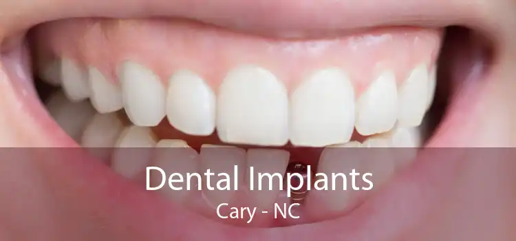 Dental Implants Cary - NC