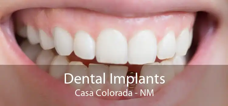 Dental Implants Casa Colorada - NM