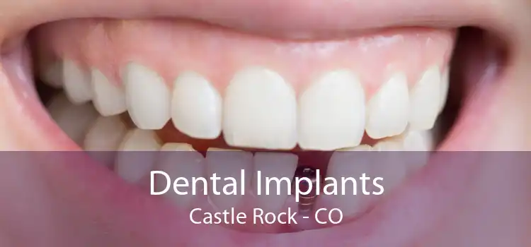 Dental Implants Castle Rock - CO