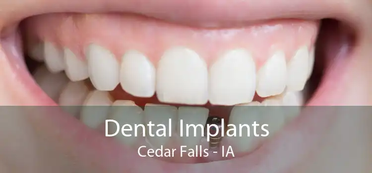 Dental Implants Cedar Falls - IA