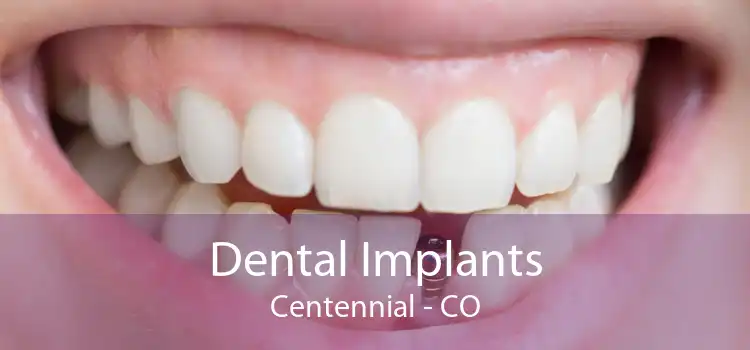 Dental Implants Centennial - CO
