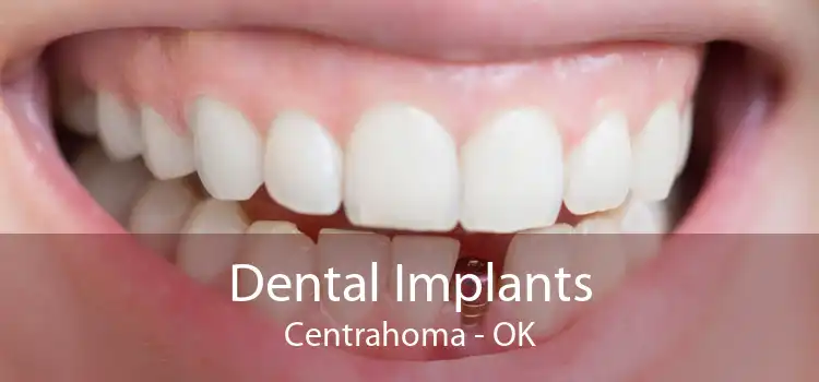 Dental Implants Centrahoma - OK