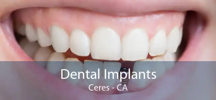 Dental Implants Ceres - CA