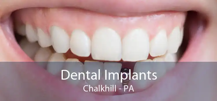 Dental Implants Chalkhill - PA