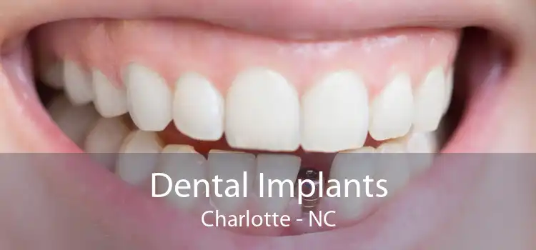 Dental Implants Charlotte - NC
