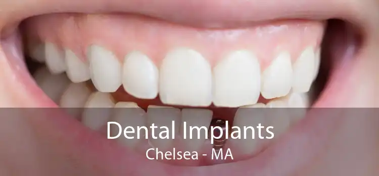 Dental Implants Chelsea - MA
