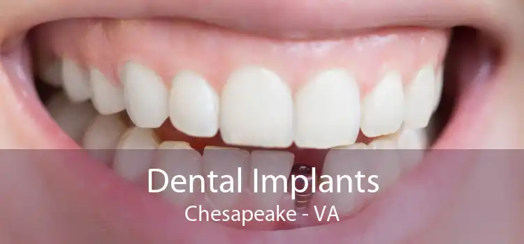 Dental Implants Chesapeake - VA