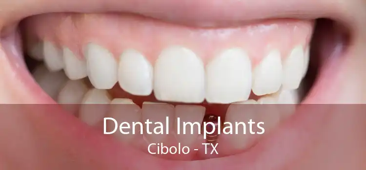 Dental Implants Cibolo - TX