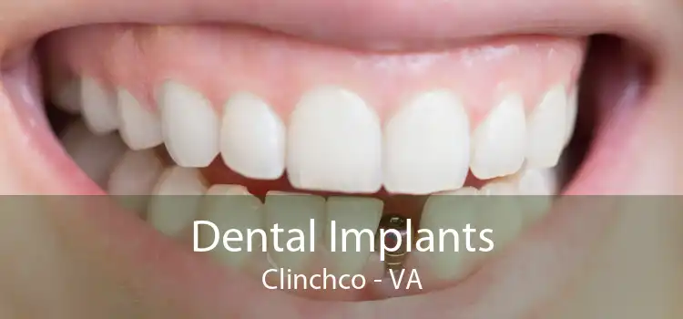 Dental Implants Clinchco - VA