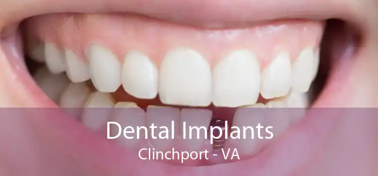 Dental Implants Clinchport - VA