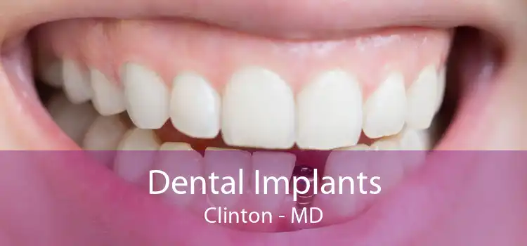 Dental Implants Clinton - MD