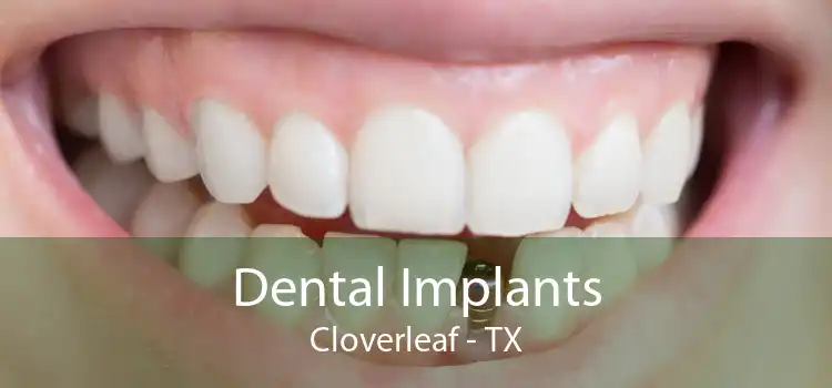 Dental Implants Cloverleaf - TX