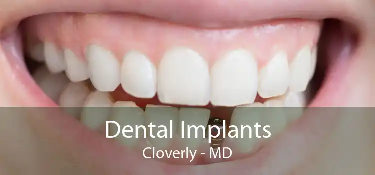 Dental Implants Cloverly - MD