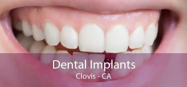 Dental Implants Clovis - CA