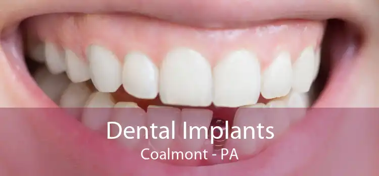 Dental Implants Coalmont - PA
