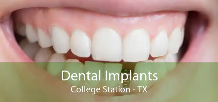 Dental Implants College Station - TX
