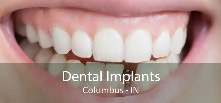 Dental Implants Columbus - IN