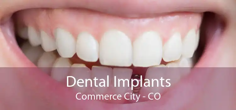 Dental Implants Commerce City - CO