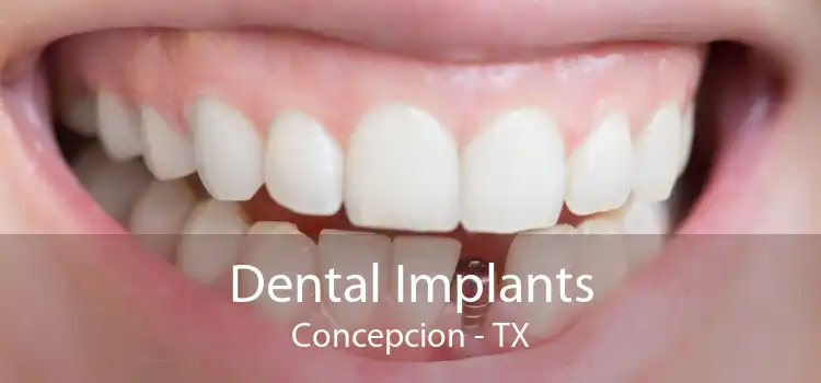 Dental Implants Concepcion - TX