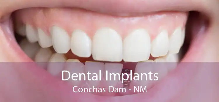 Dental Implants Conchas Dam - NM