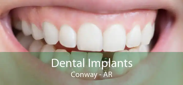 Dental Implants Conway - AR