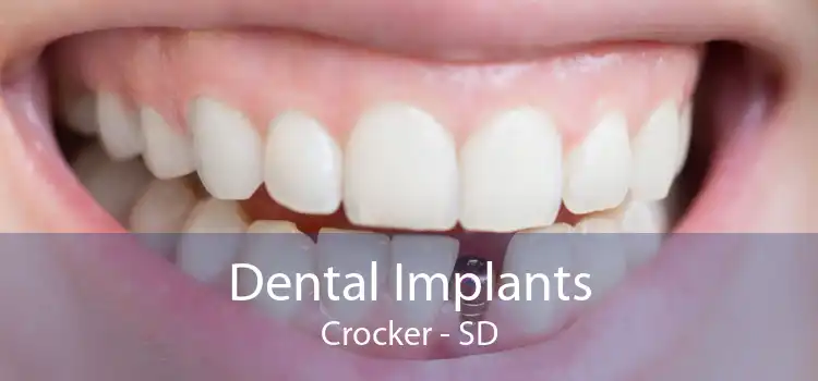 Dental Implants Crocker - SD