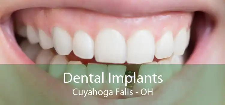 Dental Implants Cuyahoga Falls - OH