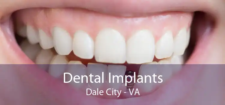 Dental Implants Dale City - VA