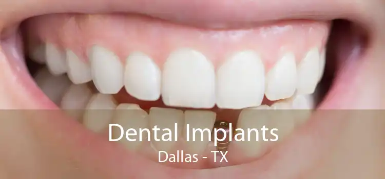 Dental Implants Dallas - TX