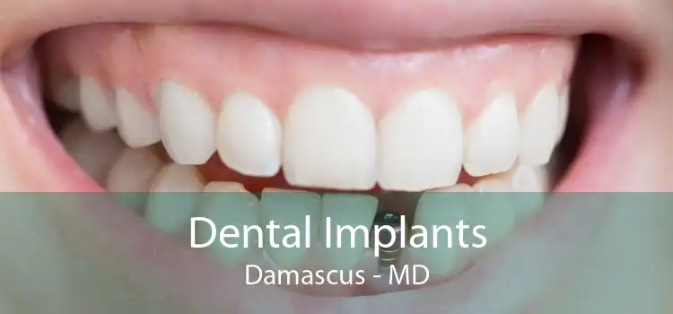 Dental Implants Damascus - MD