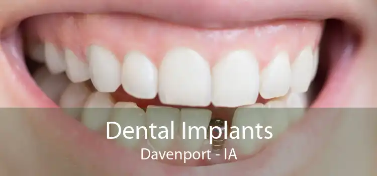 Dental Implants Davenport - IA