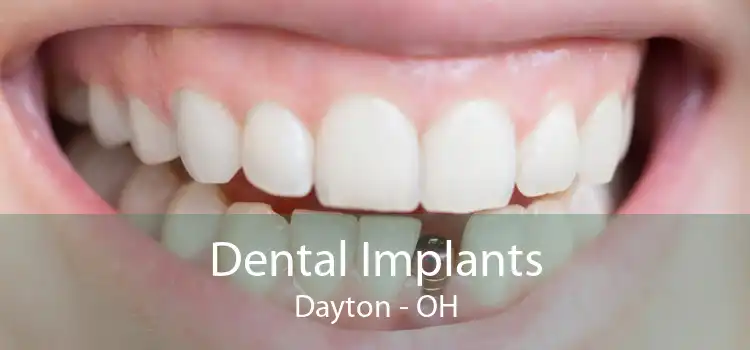 Dental Implants Dayton - OH