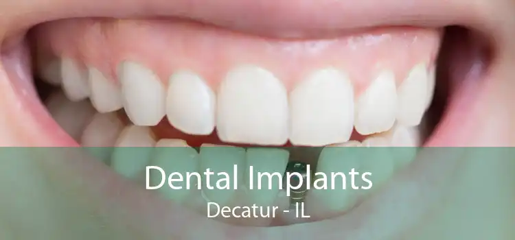Dental Implants Decatur - IL