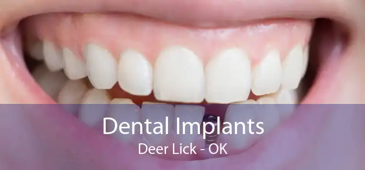 Dental Implants Deer Lick - OK