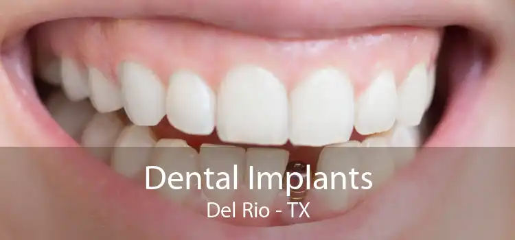 Dental Implants Del Rio - TX