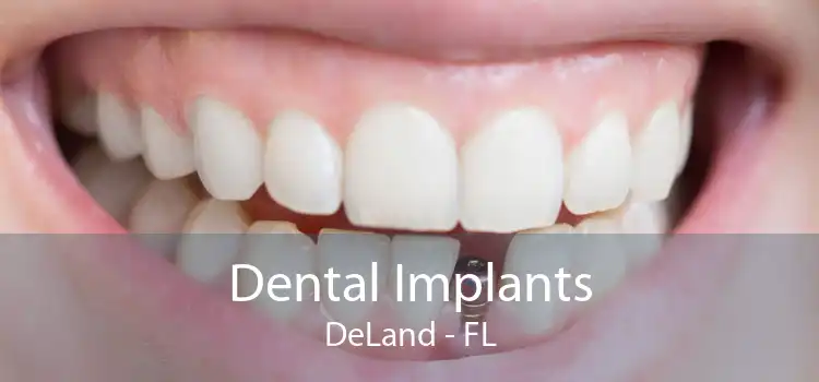 Dental Implants DeLand - FL
