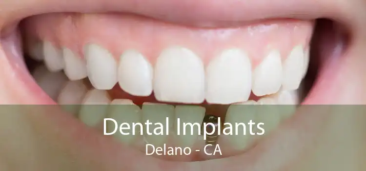 Dental Implants Delano - CA