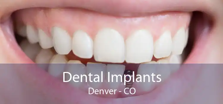 Dental Implants Denver - CO