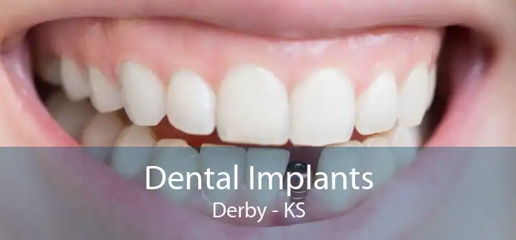 Dental Implants Derby - KS