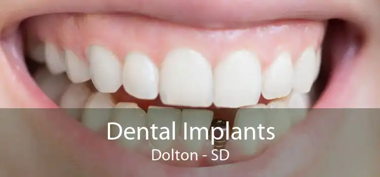 Dental Implants Dolton - SD