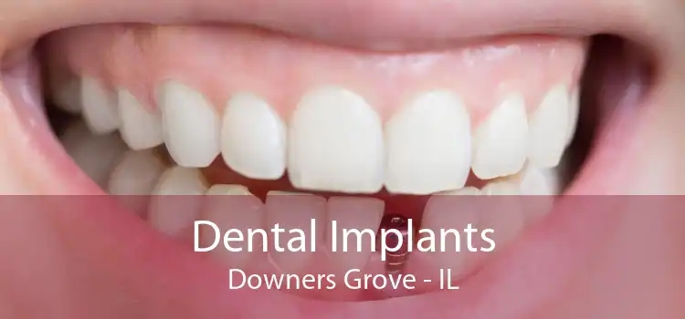 Dental Implants Downers Grove - IL