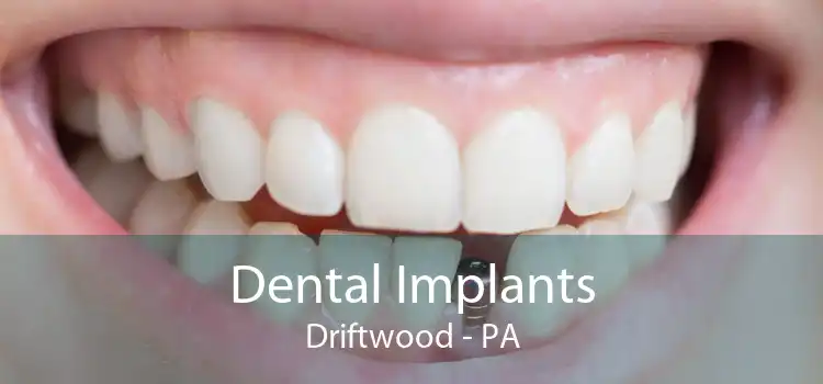 Dental Implants Driftwood - PA