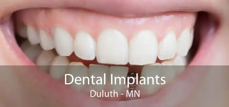 Dental Implants Duluth - MN