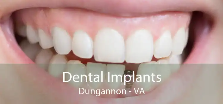 Dental Implants Dungannon - VA