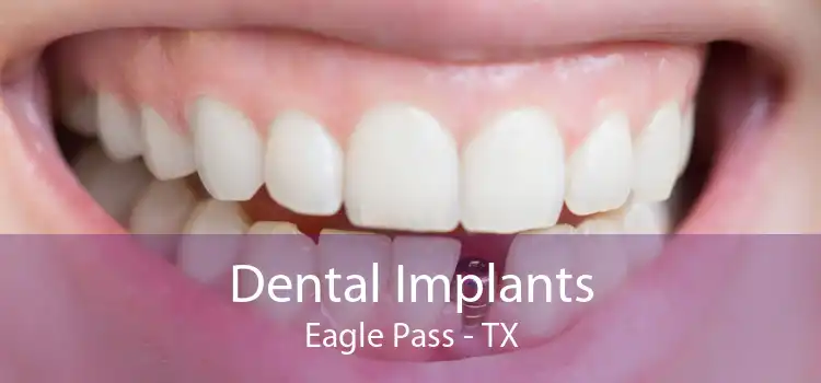 Dental Implants Eagle Pass - TX