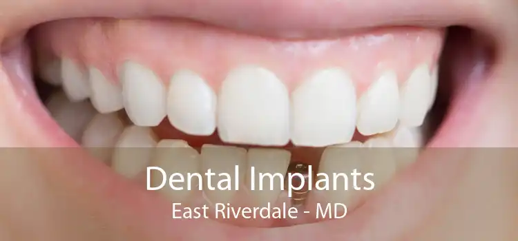 Dental Implants East Riverdale - MD