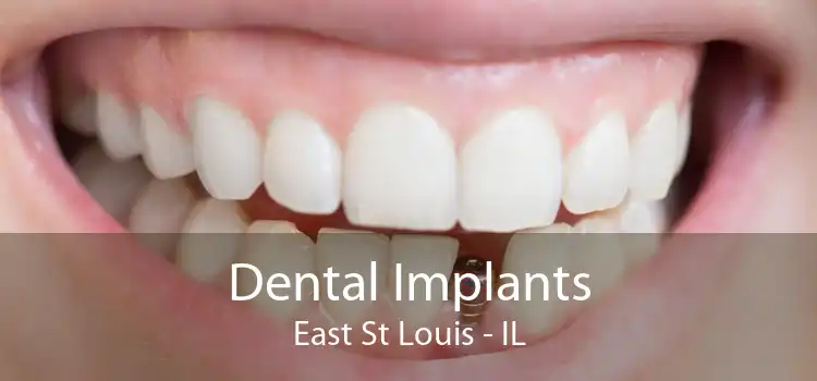 Dental Implants East St Louis - IL