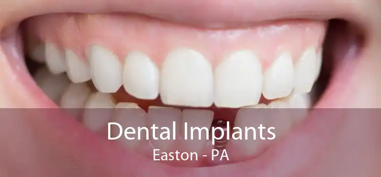 Dental Implants Easton - PA