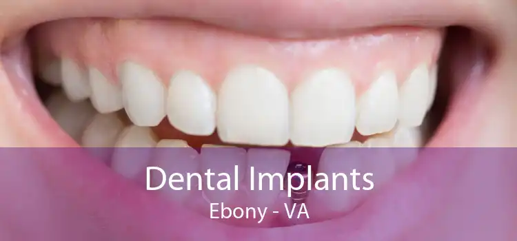 Dental Implants Ebony - VA