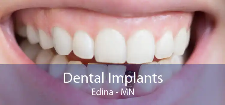 Dental Implants Edina - MN